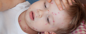 5 Alergi Kulit yang Sering di Alami Bayi