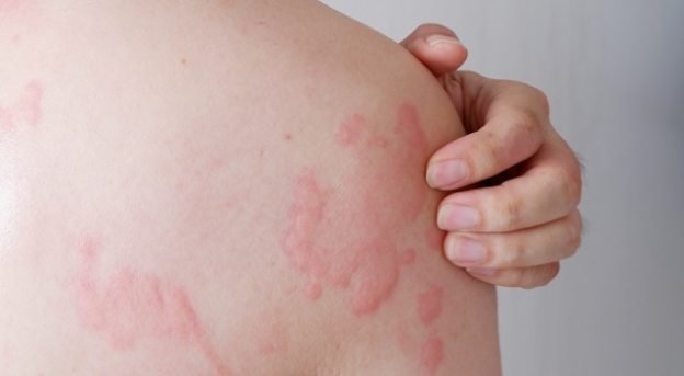 10 Pilihan Obat Alergi Dingin Secara Alami